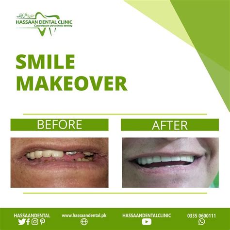 Smile Makeover Smile Makeover Dental Veneers Cosmetic Dentistry