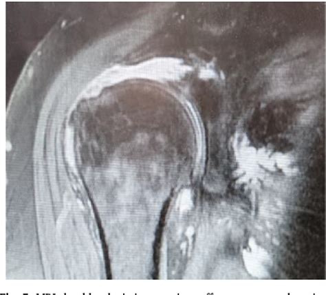 Figure 5 From The Use Of A Subacromial Spacer Inspace Balloon In Managing Patients With