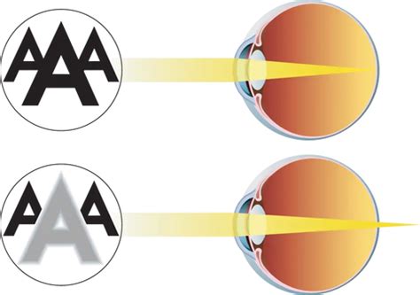 Presbyopia — Lais Opticians