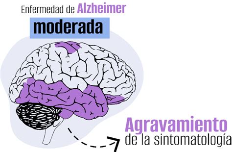 Fases del Alzhéimer Roche Pacientes