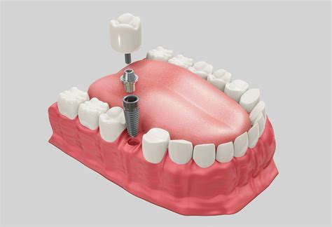 Implantes dentales de carga inmediata en Badalona Clínica dental La