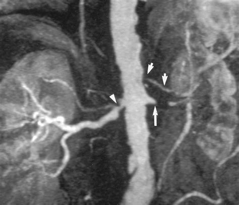 Accuracy Of Normal Dose Contrast Enhanced Mr Angiography In Assessing Renal Artery Stenosis And