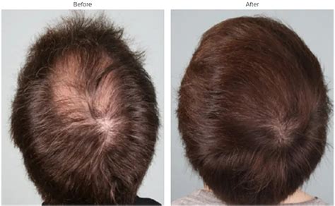 Prp Hair Restoration Procedure In Burlington Flawless Medspa