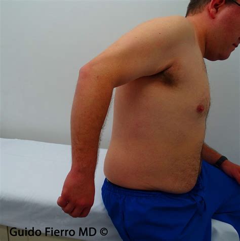 Ruptura Del Tr Ceps Distal Guido Fierro