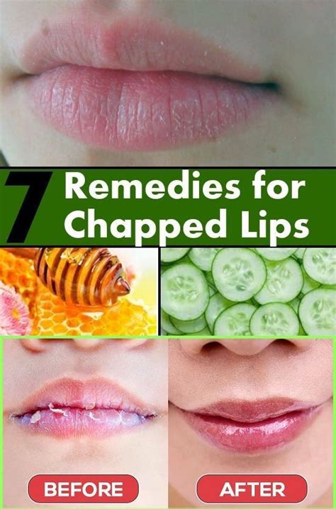 7 Home Remedies That Can Treat Dry Chapped Lips Dry Lips Chapped