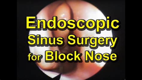 Endoscopic Sinus Surgery Maxillary Sinus Disease Youtube