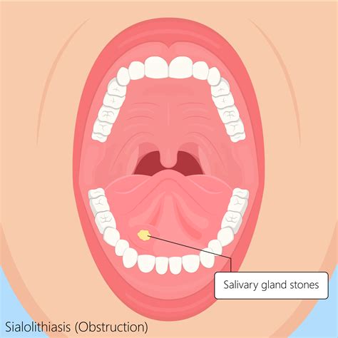 Treatments Of The Oral Cavity And Salivary Glands