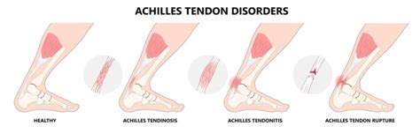 ACHILLES TENDON TEAR - Midwest Orthopaedics