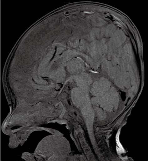 T1 Weighted Sagittal Magnetic Resonance Image Of The Brain Showing