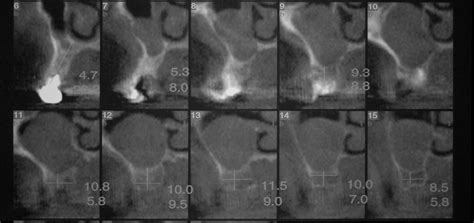 Maxillary Sinus Polyp Semantic Scholar