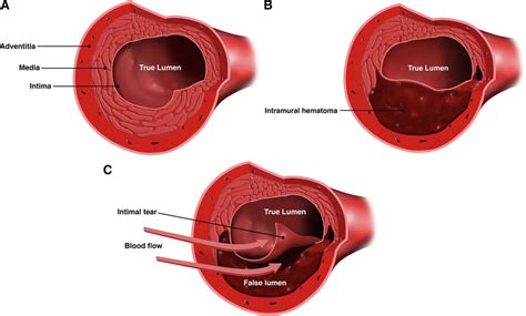 Spontaneous Coronary Artery Dissection Current State Of The Science A