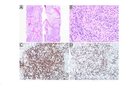 Bone Marrow Biopsy A Nodular Lymphoid Infiltrate Occupies The Marrow