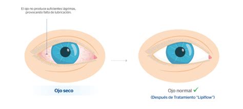 Ojo Seco Qué Es Causas Síntomas Y Tratamientos Clínica Baviera