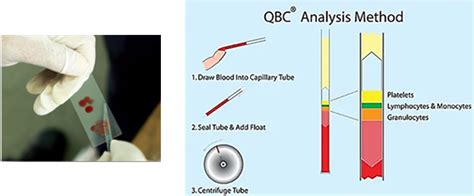 diagnosis  treatment  malaria integration