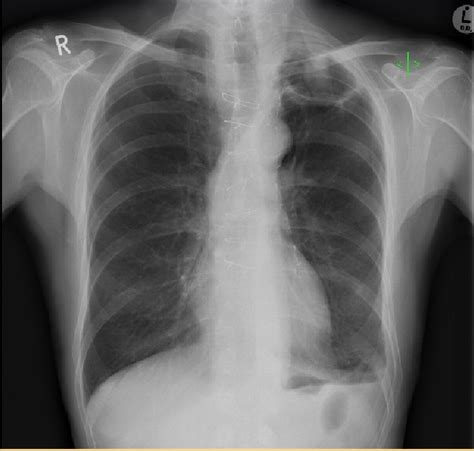 Apical Pneumonia