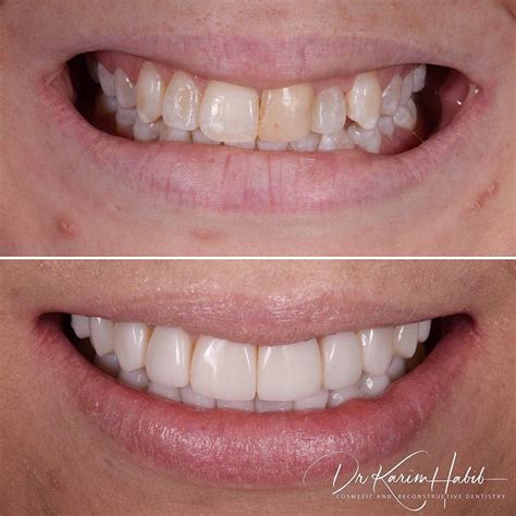 Composite Veneers Sydney Dental Bonding Sydney Dentist Ryde