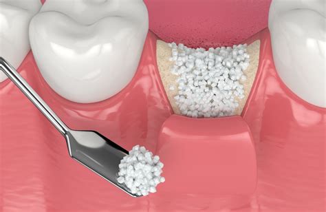 Bone Graft Hamlin Dental Group