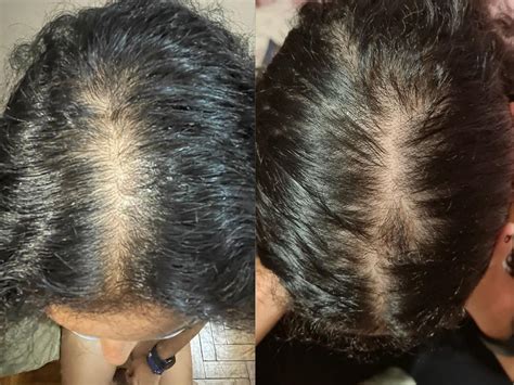 Stopping Androgenic Alopecia in Women - Marilia's testimonial ...