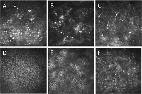 Acanthamoeba Keratitis Confocal