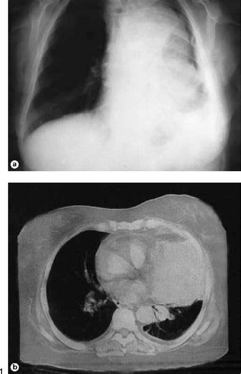 Mediastinal Yolk Sac Tumor Semantic Scholar