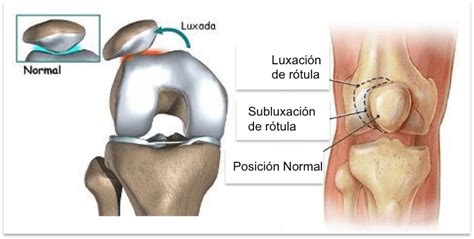 Luxación de rótula en la rodilla causas síntomas y tratamiento