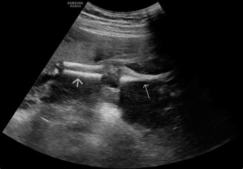 Antenatal Diagnosis Of Sirenomelia The Mermaid Syndrome With Bilateral