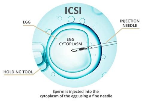 The Role Intracytoplasmic Sperm Injection Icsi Plays In Ivf Bridge Clinic