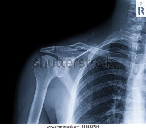 Film Xray Clavicle Ap View Fracture Foto Stock 586833704 Shutterstock