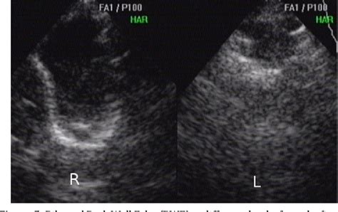 [pdf] Ultrasound Of Maxillary Sinus Semantic Scholar