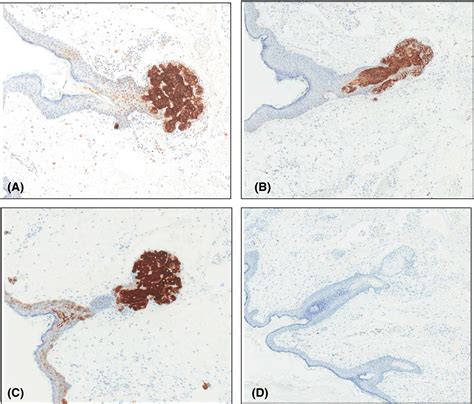 Perforin Expression In Eyelid Sebaceous Carcinomas A Useful And