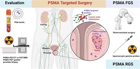 Prostate Specific Membrane Antigen Targeted Surgery In Prostate Cancer