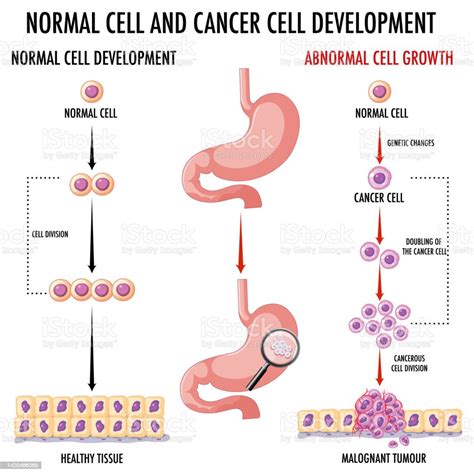 Diagram Showing Normal And Cancer Cells In Human Stock Illustration ...