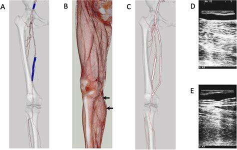 Case 1 A Preoperative Computed Tomography Angiography Revealed The