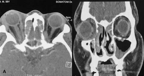 Ct Scan Imaging Of The Orbit And Paranasal Sinuses A Axial View