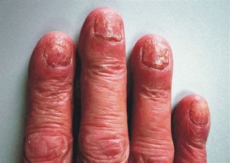 Clinical changes in psoriasis: "oil spot" (left) and nail pitting ...