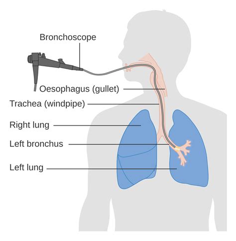 15 Unique Bronchoscopy Procedure Note