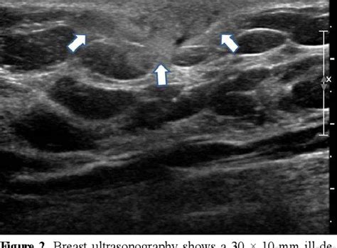 Figure From A Case Of Sparganosis That Mimicked Recurrence Of