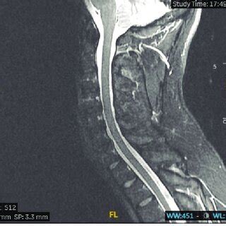 Mri Cervical T Weighted Sagittal Section Showing No Hemorrhage Edema