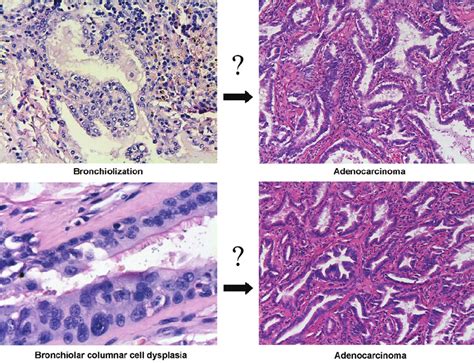 Probable Multistep Progression To Invasive Adenocarcinoma Download Scientific Diagram