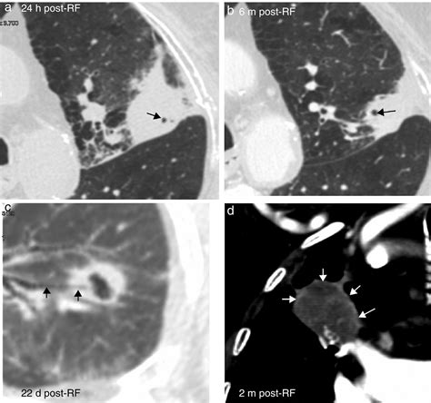 Pulmonary radiofrequency ablation (Part 2): Procedure and follow-up ...