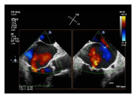 Transesophageal Echocardiogram With Doppler Color Flow Analysis