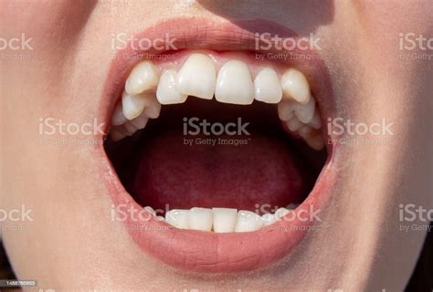 Curved Female Teeth Before Installing Braces Close Up Stock Photo