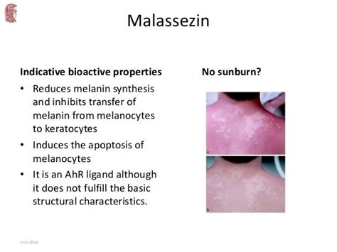 Update On Malassezia Associated Skin Diseases1