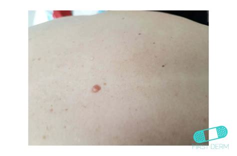 Online Dermatology Intradermal Nevus