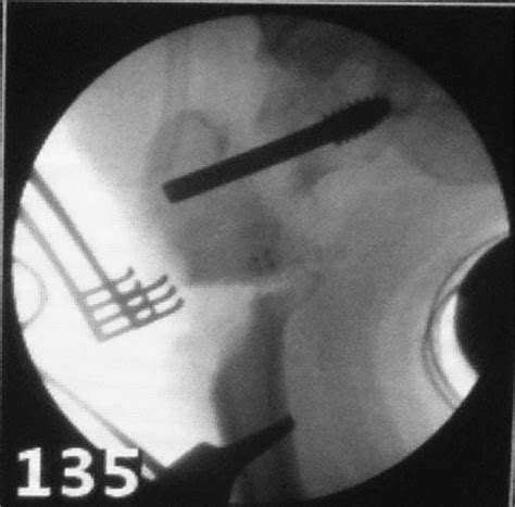 SciELO Brasil Long Term Outcome Of Valgus Osteotomy And Fixation