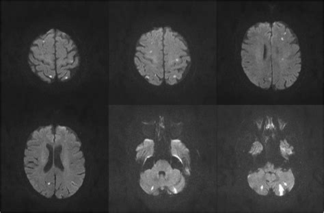 Axial Dwi Mri Displaying Hyperintense Signals In Both Hemispheres In