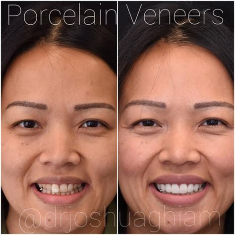 Porcelain Veneers Specialist Los Angeles Dentist Porcelain