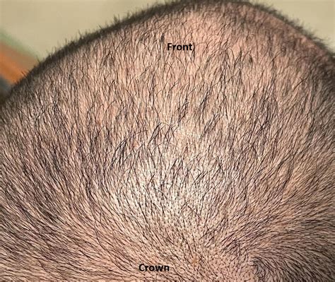 42 Year Old Male 3 Months On Minoxidil And Finasteride Photo