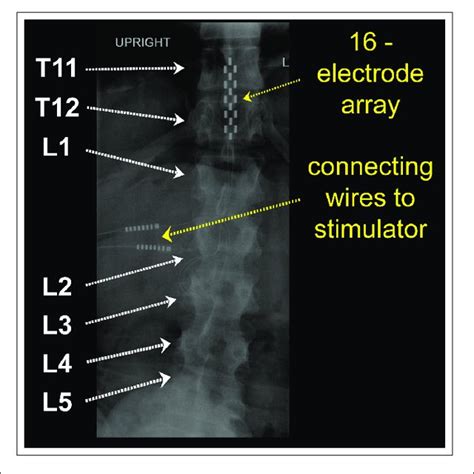 Effect Of Acute Epidural Spinal Cord Stimulation Escs On Lower Download Scientific Diagram