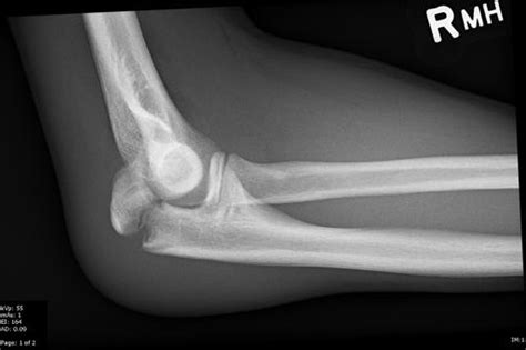 Olecranon Fracture Physiopedia